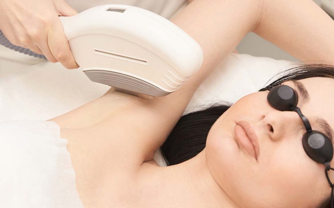 hair laser removal