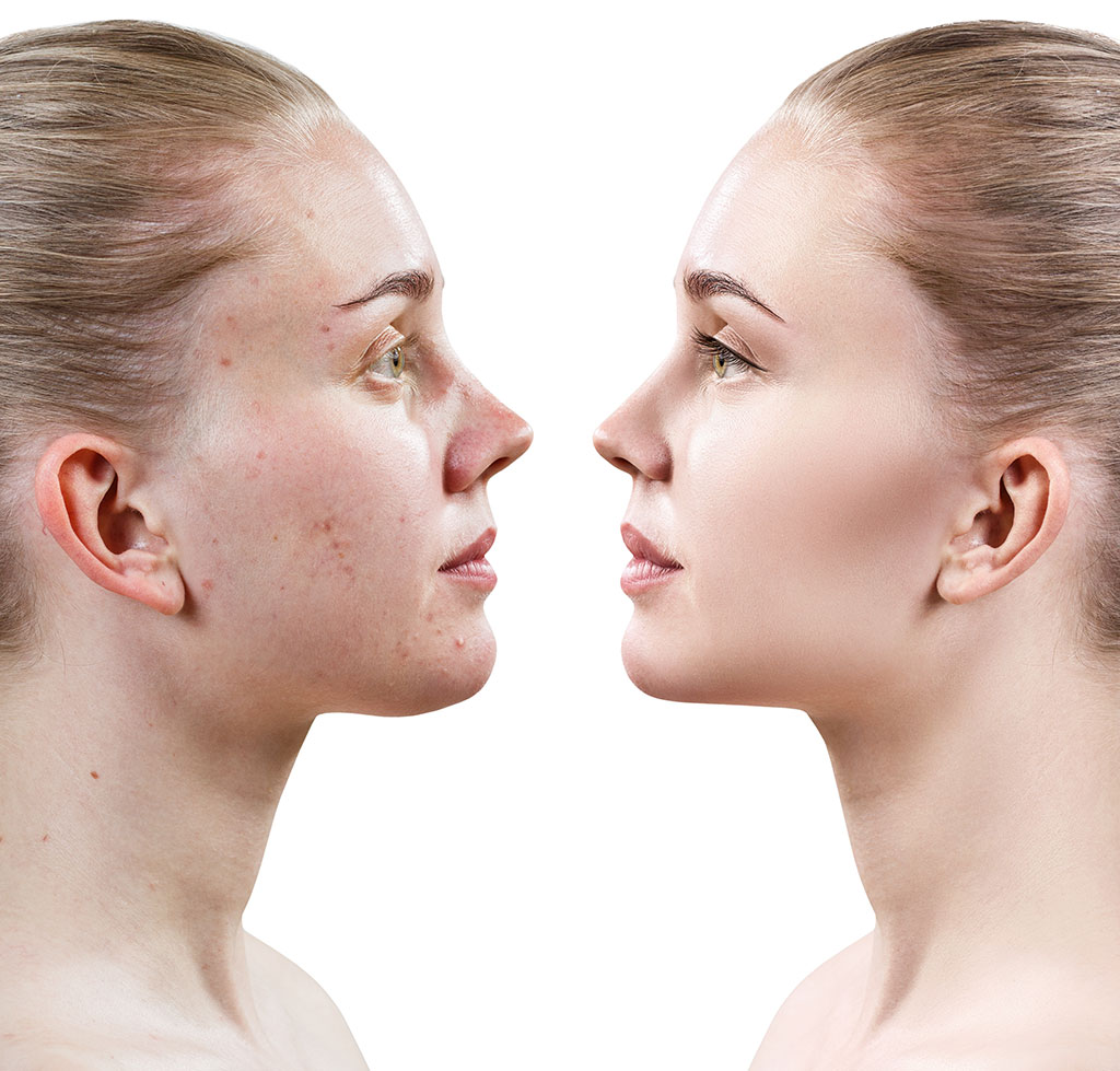 Acne Treatment Etobicoke